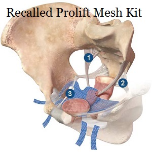 prolift_mesh_implant_anterior_111405