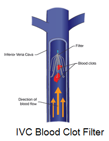 Bard IVC Filter Lawsuit | Blood Clot Filter Lawyer