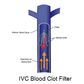 IVC Filter Graphic