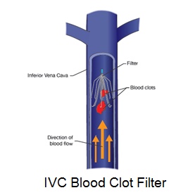 ivc_filter