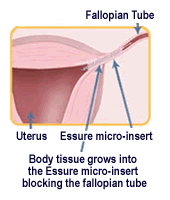 Essure Safety examined by FDA